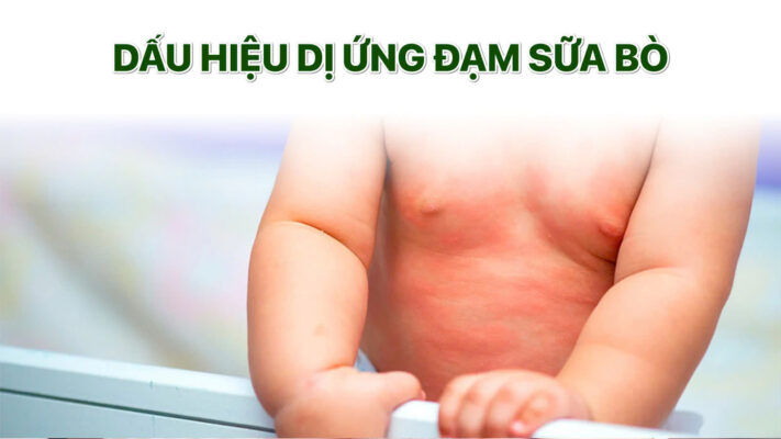 dau hieu di ung dam sua bo